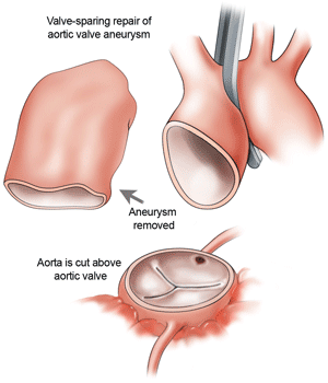 Aorta Artery Replacement Surgery