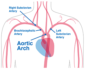 The RelayBranch Trial Introduces the First Minimally-Invasive Device for Total Aortic Arch Repair | Columbia University Department of Surgery The RelayBranch Trial Introduces the First Minimally-Invasive Device for Total Aortic Arch Repair | Columbia University Department of Surgery