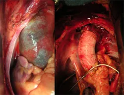 Before and after surgery to correct Type A dissection
