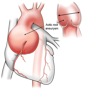 aortic root anatomy