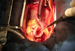 Reimplantation of Aortic Valve