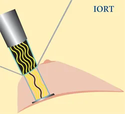 Intraoperative Radiation Therapy (IORT)