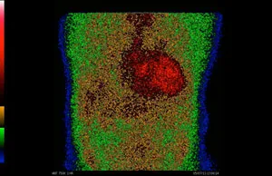 Cardiac Amyloid