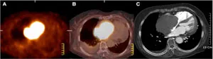 Angiosarcoma