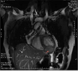 Cardiac Hemangioma