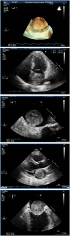 Heart Tumor Symptoms, Types & Treatment | Columbia Surgery