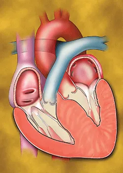 Heart with HCM
