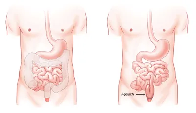 When the large intestine and rectum are removed due to colorectal disease, another pathway must be devised for solid waste to exit the body. A J-pouch, a surgically created 