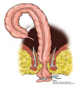 The Turnbull-Cutait procedure may be performed to avoid a permanent ostomy in certain extenuating circumstances.