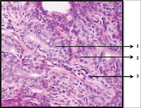 Named Orphan Annie Nuclei because the appearance of these abnormal nuclei resembles the “Eyes Of Orphan Annie” from the daily comic strip by Harold Gray.