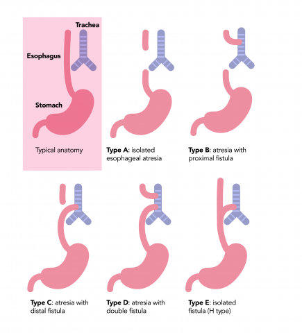 Types of EA The five types of EA/TEF