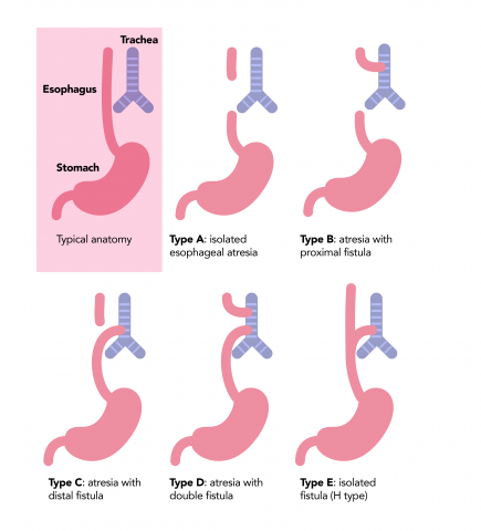 esophageal atresia repair