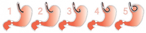 Step by step illustration of incisionless trans-oral treatment for GERD.