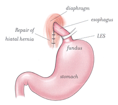 hiatus hernia fixed