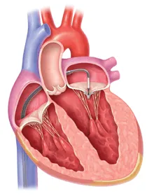 MitraClip is the world’s first percutaneous procedure available to repair the mitral valve. Courtesy of Abbott Vascular (copyright symbol) 2013 Abbott Laboratories. All Rights Reserved.