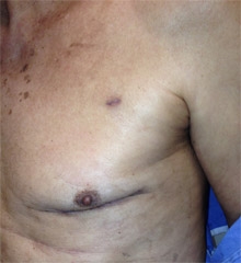 Robotic LIMA-LAD incision