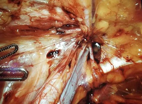 From Dr. Novitsky’s twitter account: Beautiful visualization of the critical view of the left myopectineal orifice during robotic left femoral hernia repair #surgicalart