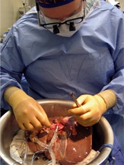 A donated liver that has been stored with advanced machine preservation methods