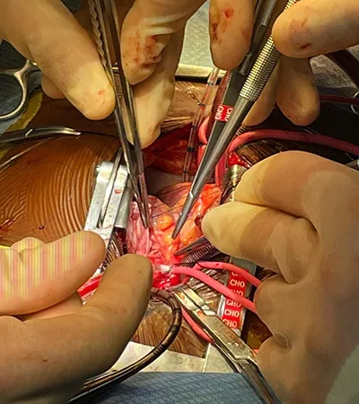 Close-up of tetrology of Fallot repair