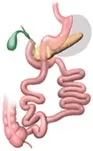 Duodenal Switch