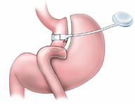 Laparoscopic Gastric Banding Columbia University Department Of Surgery