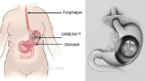 Gastric Balloon