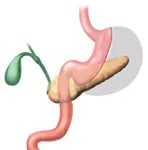 Gastric Sleeve