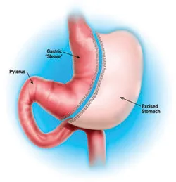 Sleeve Gastrectomy