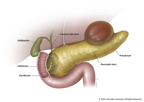 Acute Pancreatitis