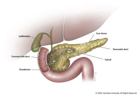 Chronic Pancreatitis