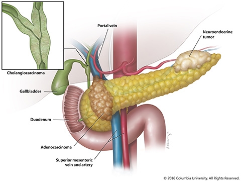 Pancreatic tumor