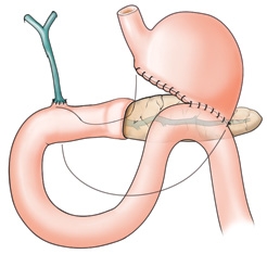 whipple procedure for pancreatitis