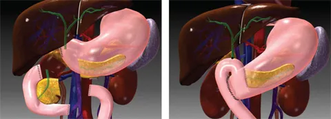The Whipple procedure is the most common pancreatic cancer operation. A portion of the pancreas is removed, together with the lower portion of the stomach, the duodenum the gallbladder, and part of the common bile duct. 