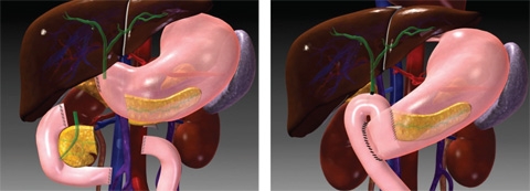 Pancreatic Surgery | Columbia University Department of Surgery