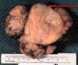 Parathyroid Cancer