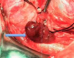 Parathyroid Adenoma