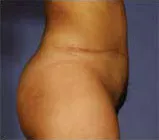 Post-op