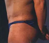 Post-op