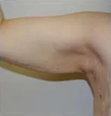 Post-op