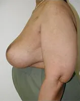 Post-op