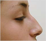 Cosmetic Nose Surgery (Rhinoplasty) | Columbia Surgery