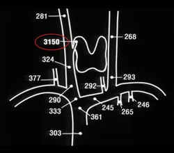 Selective venous sampling showing results showing the area of increased hormone production