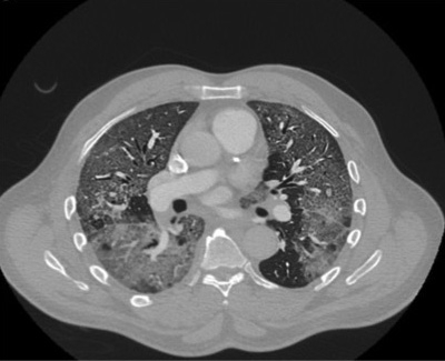 Chest CT showing ground glass opacities. Contributed by Moiz Salahuddin, MD to the NIH.