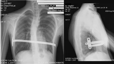 X-ray of a 15 year old male after undergoing the Nuss procedure.