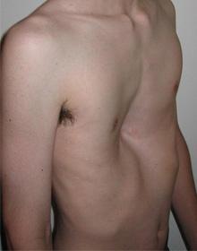 innovative new treatment reported for pectus excavatum columbia surgery