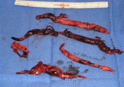 Acute pulmonary blockages extracted from the lung