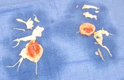 Blockage extracted from the lung during a pulmonary thromboendarterectomy (PTE) procedure to relieve thromboembolic pulmonary hypertension (CTEPH).