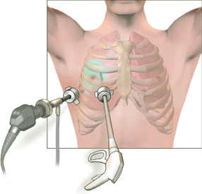 Minimally Invasive and Video-Assisted Thoracic Surgery (VATS) | Columbia University Department of Surgery