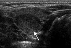 benign thyroid nodules