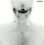 RAI Scan demonstrating thyroid cancer recurrence in the neck